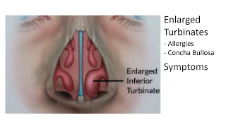 Enlarged Nasal Turbinates, Symptoms, and Treatment