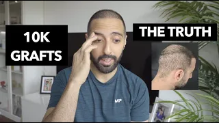 10k Grafts 2nd Hair Transplant - My Honest Review (again)