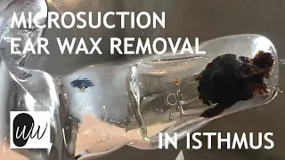 Microsuction Ear Wax Removal of Ear Wax Stuck in Isthmus of Ear Canal - #396