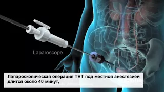 Отзыв о лечение недержания мочи в Израиле