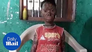 'Snake girl' who sheds skin every six weeks due to get treatment - Daily Mail