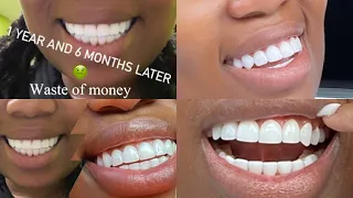 MY BAD EXPERIENCE + WASTE OF MONEY WITH VENEERS --- I HAD TO GET THEM RE-DONE | EXPLAINED