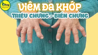 Viêm khớp dạng thấp là gì, người bệnh cần kiêng gì?