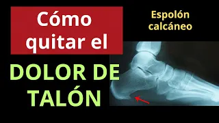 CÓMO QUITAR EL DOLOR DE TALÓN: ESPOLÓN CALCÁNEO Y FASCITIS PLANTAR