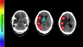 Perfusion Imaging Part 1 | Free Radiology CME