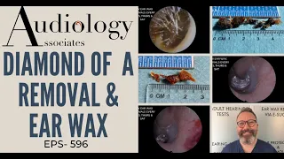 EAR WAX & DIAMANTE REMOVAL - EP596