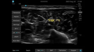 Ultrasound to find superficial peroneal nerve in 10 seconds (with caption)