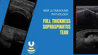 Full thickness Supraspinatus tendon tear on ultrasound