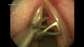 Vocal Cord Polyp surgery