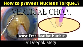 Phaco Vertical Chop: How to prevent Torque in a dense free floating Nucleus: Hypermature Cataract.
