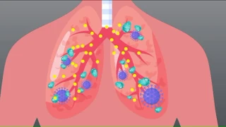 How COVID-19 attacks the body and why it impacts some more than others