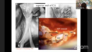 Safely opening the cavernous sinus   as illustrated in symptomatic intracavernous aneurysms