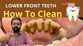 How to CLEAN Dirty Teeth at Home | Plaque Removal from Bottom  Front Teeth