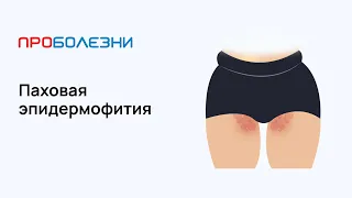 Паховая эпидермофития