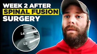Beginning the Journey: What To Expect in Weeks 1 & 2 after L4-L5 Spinal Fusion Recovery