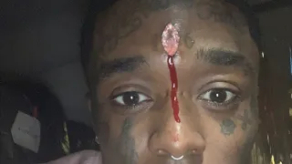 Lil Uzi Vert Could Die because his diamonds face implant he said on his twitter page