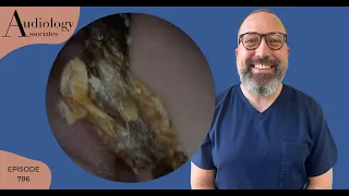 6CM/2.5IN EAR WAX REMOVAL, DRY CRUMBLY EAR WAX & EXCESS SKIN REMOVAL - EP786