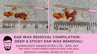 EAR WAX REMOVAL - DEEP & STICKY EAR WAX REMOVAL - EP 241