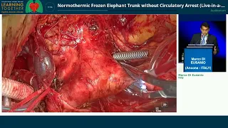 Normothermic Frozen Elephant Trunk without Circulatory Arrest Live in a box