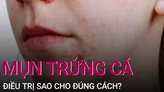 Mụn trứng cá: Điều trị thế nào mới đúng cách? | VTC Now