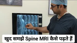 खुद समझे Spine MRI कैसे पढ़ते हैं ( ☎️ +919654095717)