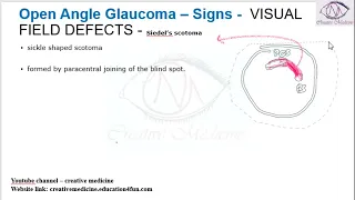 Lec 9 Open Angle Glaucoma – Signs    VISUAL FIELD DEFECTS   Bjerrum’s or Arcuate scotoma mp4