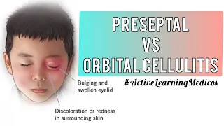 Preseptal Vs Orbital Cellulitis #EYE @ActiveLearningMedicos