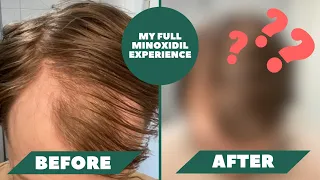 I Have Been Using Minoxidil For 1 Year And Here Are The Results - My Full Minoxidil Experience