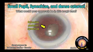 CataractCoach™ 1879: small pupil, synechiae, and dense cataract