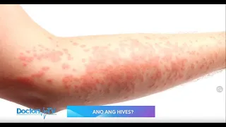 HIVES: Symptoms and Treatment