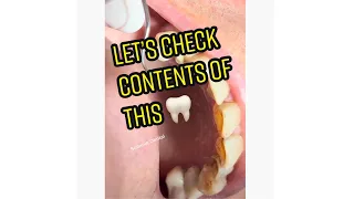 Let’s see whats inside this tooth 🦷😫 #shorts #viral #teeth #tiktok