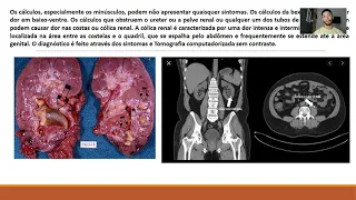 Litiase Renal e Hidronefrose