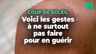 Après un coup de soleil, voici ce qu’il ne faut surtout pas faire