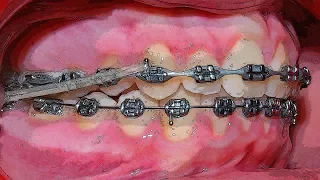 INTERMAXILLARY ELASTICS | Tom Nasiopoulos Orthodontist