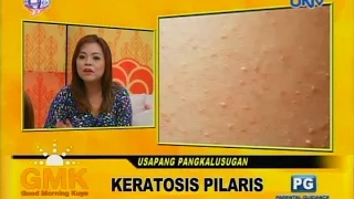 Keratosis Pilaris (chicken skin)