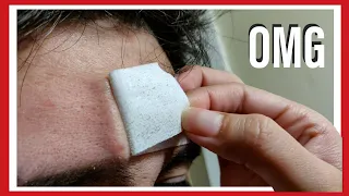 #Blackhead #asmr removal peel off Forehead, Cheeks & Nose strips ULTRA HIGH QUALITY close up.