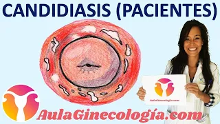 CANDIDIASIS VAGINAL (PACIENTES): Causas, síntomas, tratamiento   - Ginecología y Obstetricia -