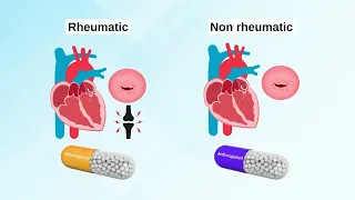 Atrial fibrillation