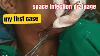 Submandibular & submental space infection surgery video ||incision &drainage||odontogenic infection