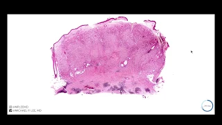 Microcystic adnexal carcinoma explained by a dermatopathologist. Dermpath made easy.