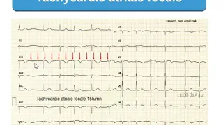 troubles de rythme supraventriculaires