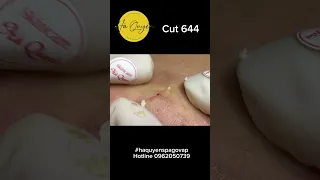 Cut 644 Acne of men U30 ep1 #treatments #acne #blackheads