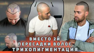 Трихопигментация вместо 2й пересадки волос! Визуальное загущение прически. Scalp Micropigmentation.