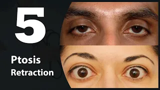 5- Eye lids (Ptosis & Retraction)