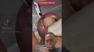 EXTRACTION OF INGROWN NAIL SPICULE💥#shorts