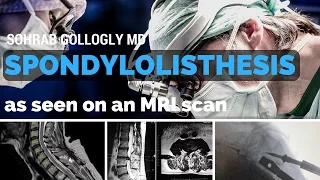 MRI scan of spondylolisthesis