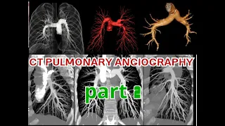 طريقة عمل الأشعة المقطعية بالصبغة على الشريان الرئوي  بالتفصيل (جزء2)  CT Pulmonary Angiography