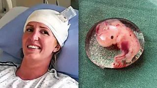 Dr Finds Womans Unborn Twin Living Inside Of Her Brain