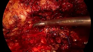 SCOLA for umbilical hernia with divarication of recti.