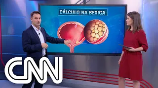 Quais os riscos de um cálculo renal e como prevenir? - Correspondente Médico